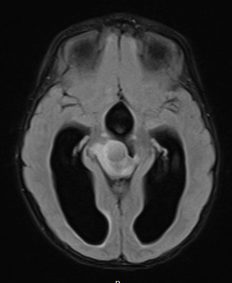 2A3 Papillary Tumor of the Pineal Region (Case 2)  FLAIR Axial - Copy