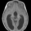 2A4 Papillary Tumor of the Pineal Region (Case 2) T1noC axial - Copy