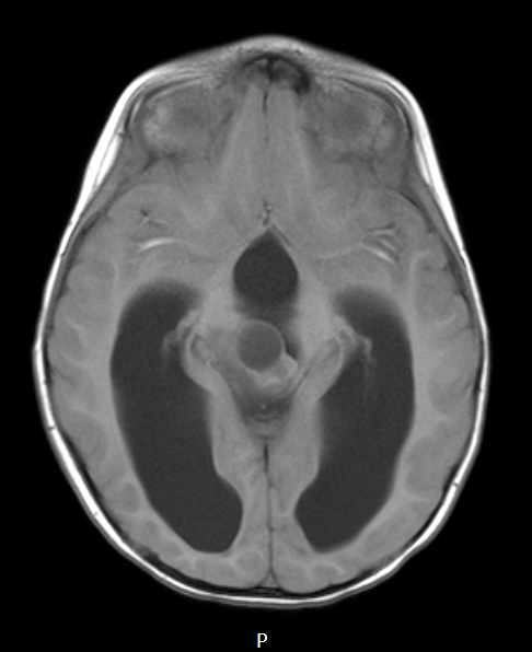 2A4 Papillary Tumor of the Pineal Region (Case 2) T1noC axial - Copy