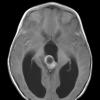 2A5 Papillary Tumor of the Pineal Region (Case 2) T1W axial - Copy