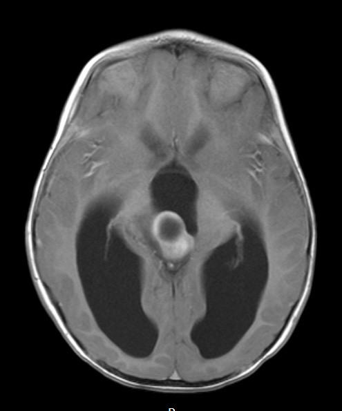 2A5 Papillary Tumor of the Pineal Region (Case 2) T1W axial - Copy