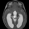 2A6 Papillary Tumor of the Pineal Region (Case 2) T2 Axial - Copy