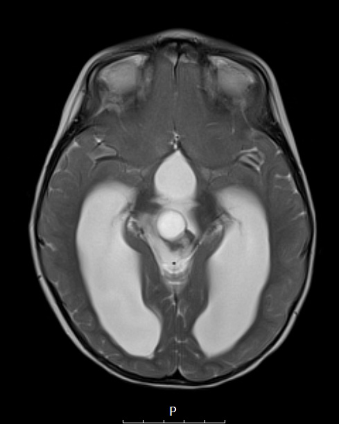 2A6 Papillary Tumor of the Pineal Region (Case 2) T2 Axial - Copy