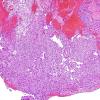 2B1 Papillary Tumor of the Pineal Region (Case 2) H&E 12.jpg