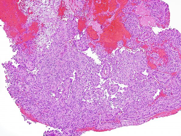 2B1 Papillary Tumor of the Pineal Region (Case 2) H&E 12.jpg