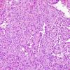 2B2 Papillary Tumor of the Pineal Region (Case 2) H&E 13.jpg