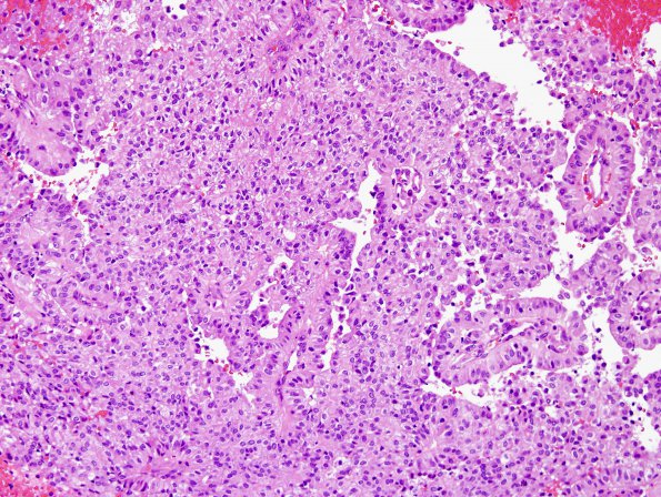 2B2 Papillary Tumor of the Pineal Region (Case 2) H&E 13.jpg