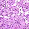 2B3 Papillary Tumor of the Pineal Region (Case 2) H&E 14.jpg