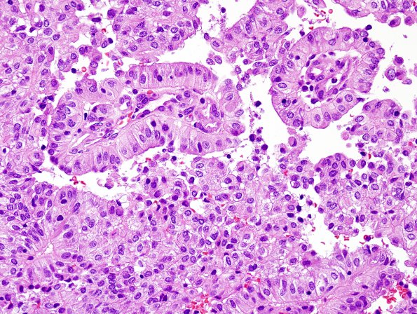 2B3 Papillary Tumor of the Pineal Region (Case 2) H&E 14.jpg