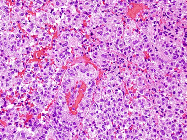 2B4 Papillary Tumor of the Pineal Region (Case 2) H&E 7.jpg