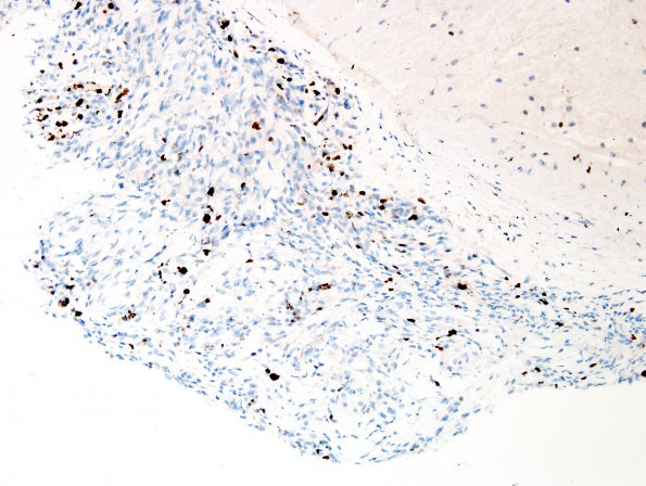 2E Papillary Tumor of the Pineal Region (Case 2) Ki67 1.jpg