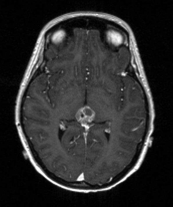 3A1 Papillary Tumor Pineal Region (PTPR) (Case 3) MRI_2_54 - Copy