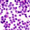 3B1 Papillary Tumor Pineal Region (PTPR) (Case 3) Smear 2.jpg