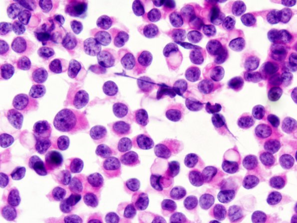 3B1 Papillary Tumor Pineal Region (PTPR) (Case 3) Smear 2.jpg