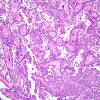 3B2 Papillary Tumor Pineal Region (PTPR) (Case 3) 1.jpg