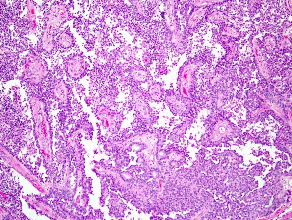 3B2 Papillary Tumor Pineal Region (PTPR) (Case 3) 1.jpg