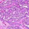 3B3 Papillary Tumor Pineal Region (PTPR) (Case 3) 7.jpg