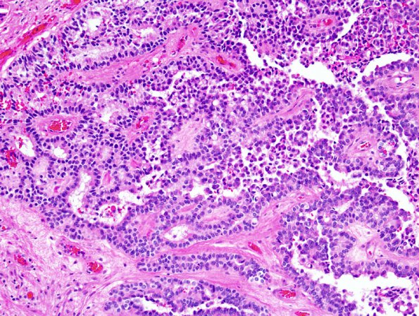 3B3 Papillary Tumor Pineal Region (PTPR) (Case 3) 7.jpg