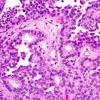 3B4 Papillary Tumor Pineal Region (PTPR) (Case 3) 3.jpg