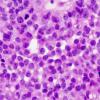 3B5 Papillary Tumor Pineal Region (PTPR) (Case 3) H&E 8.jpg