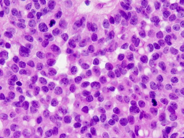 3B5 Papillary Tumor Pineal Region (PTPR) (Case 3) H&E 8.jpg