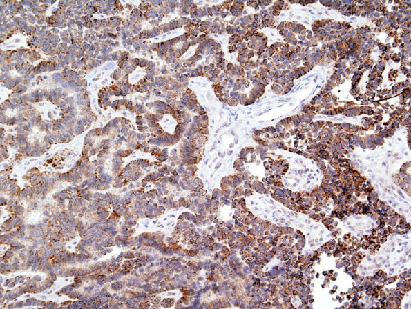 3C Papillary Tumor Pineal Region (PTPR) (Case 3) CK 1.jpg