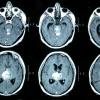 4A Papillary Tumor Pineal Region (PTPR) (Case 4) MRI 1xxx - Copy