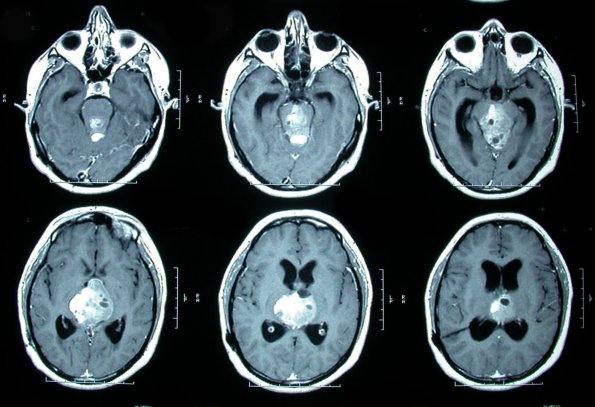 4A Papillary Tumor Pineal Region (PTPR) (Case 4) MRI 1xxx - Copy