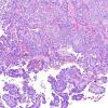 4B1 Papillary Tumor Pineal Region (PTPR) (Case 4) H&E 11