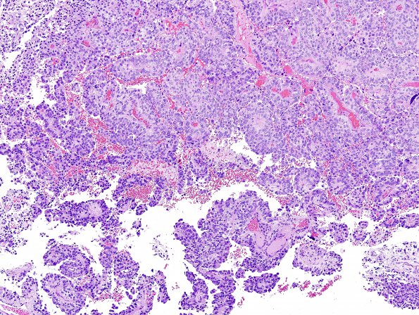 4B1 Papillary Tumor Pineal Region (PTPR) (Case 4) H&E 11