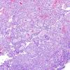 4B2 Papillary Tumor Pineal Region (PTPR) (Case 4) H&E 15