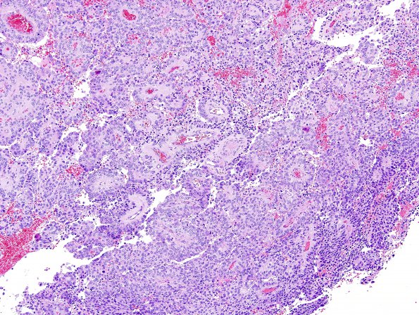 4B2 Papillary Tumor Pineal Region (PTPR) (Case 4) H&E 15