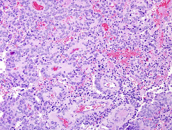 4B3 Papillary Tumor Pineal Region (PTPR) (Case 4) H&E 13