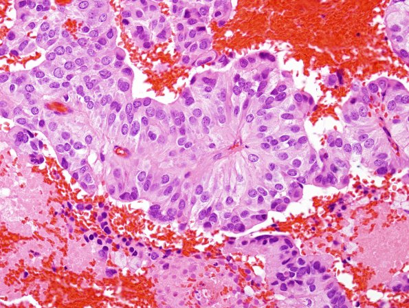 4B4 Papillary Tumor Pineal Region (PTPR) (Case 4) 10