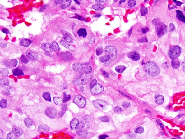 4B5 Papillary Tumor Pineal Region (PTPR) (Case 4) H&E 7.jpg