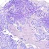 4B6 Papillary Tumor Pineal Region (Case 4) H&E 11.jpg