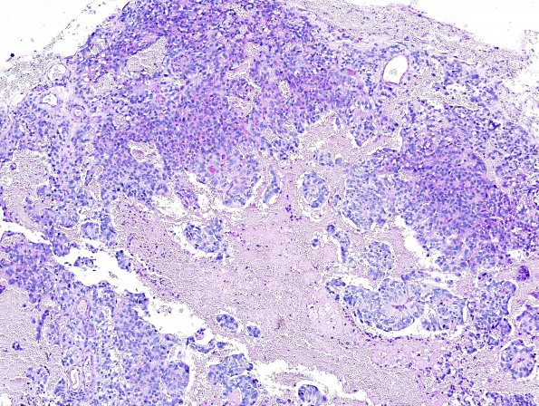 4B6 Papillary Tumor Pineal Region (Case 4) H&E 11.jpg