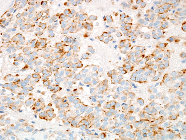 4C1 Papillary Tumor Pineal Region (Case 4) CAM52 1.jpg