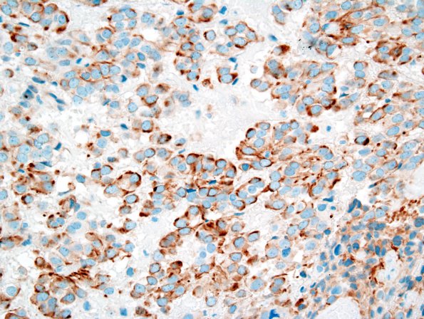 4C2 Papillary Tumor Pineal Region (PTPR) (Case 4) CAM5.2 2.jpg