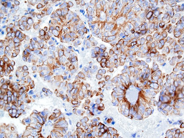 4C3 Papillary Tumor Pineal Region (PTPR) (Case 4) CK 1.jpg