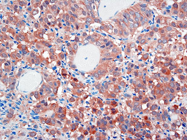 4E Papillary Tumor Pineal Region (PTPR) (Case 4) NSE 1.jpg