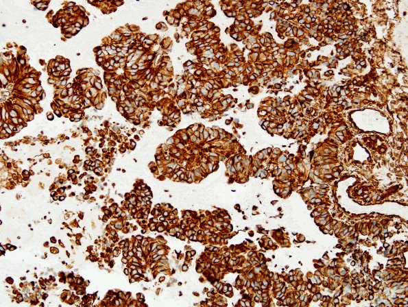 4F1 Papillary Tumor Pineal Region (Case 4) VIM 4.jpg