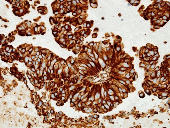 4F2 Papillary Tumor Pineal Region (Case 4) VIM 3.jpg