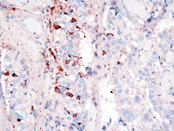 4G Papillary Tumor of the Pineal Region (PTPR) (Case 4) SYN 2.jpg