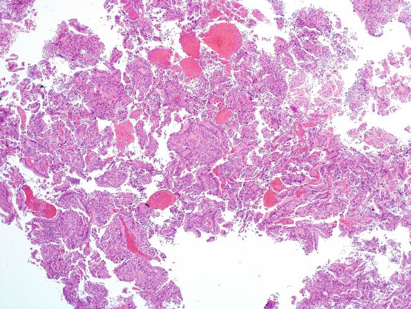 5A1 Papillary Tumor Pineal Region (Case 5) H&E 11.jpg