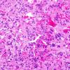 5A2 Papillary Tumor Pineal Region (PTPR, Case 5) H&E 4.jpg