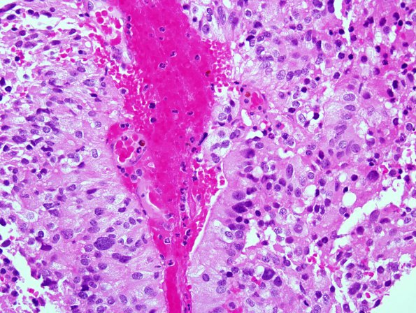 5A3 Papillary Tumor Pineal Region (PTPR, Case 5) H&E 3.jpg