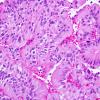 5A4 Papillary Tumor Pineal Region (PTPR, Case 5) H&E 2.jpg