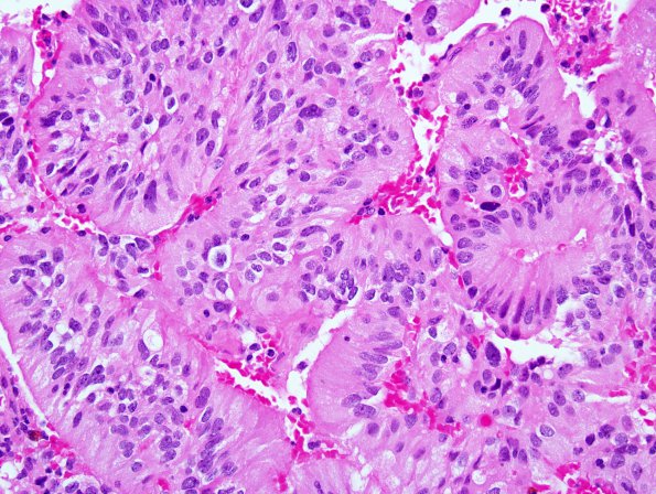 5A4 Papillary Tumor Pineal Region (PTPR, Case 5) H&E 2.jpg