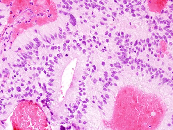 5A5 Papillary Tumor Pineal Region (Case 5) H&E 2.jpg